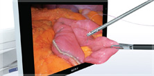 高清屏幕与三维图像腹腔镜仪器操作组织出来的屏幕