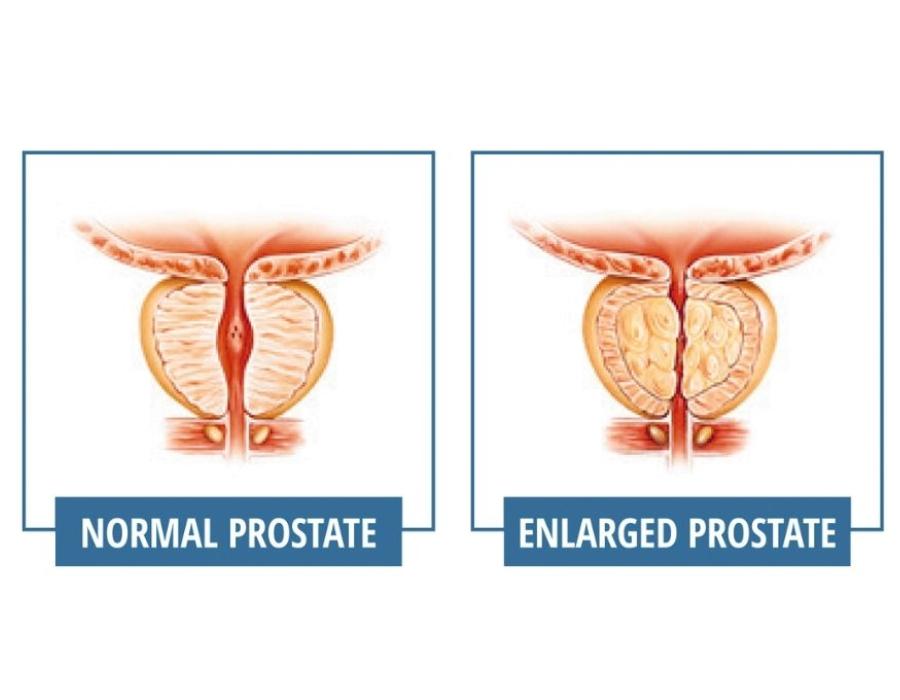 前列腺正常与前列腺肿大